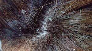 خارش سر و مو